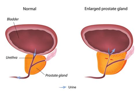This type of <strong>prostatitis</strong> often develops slowly and can last 3 or more months. . Enlarged prostate and obstructed bowel